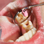 Root Canal Treatments